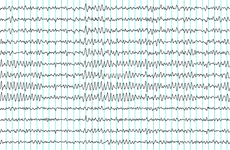 EEG waves in an Electroencephalogram.