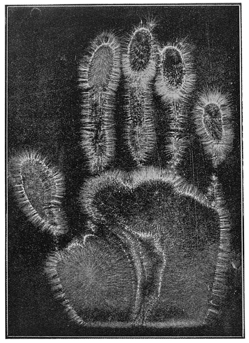 Pure electrography of the hand by Iodko's method.